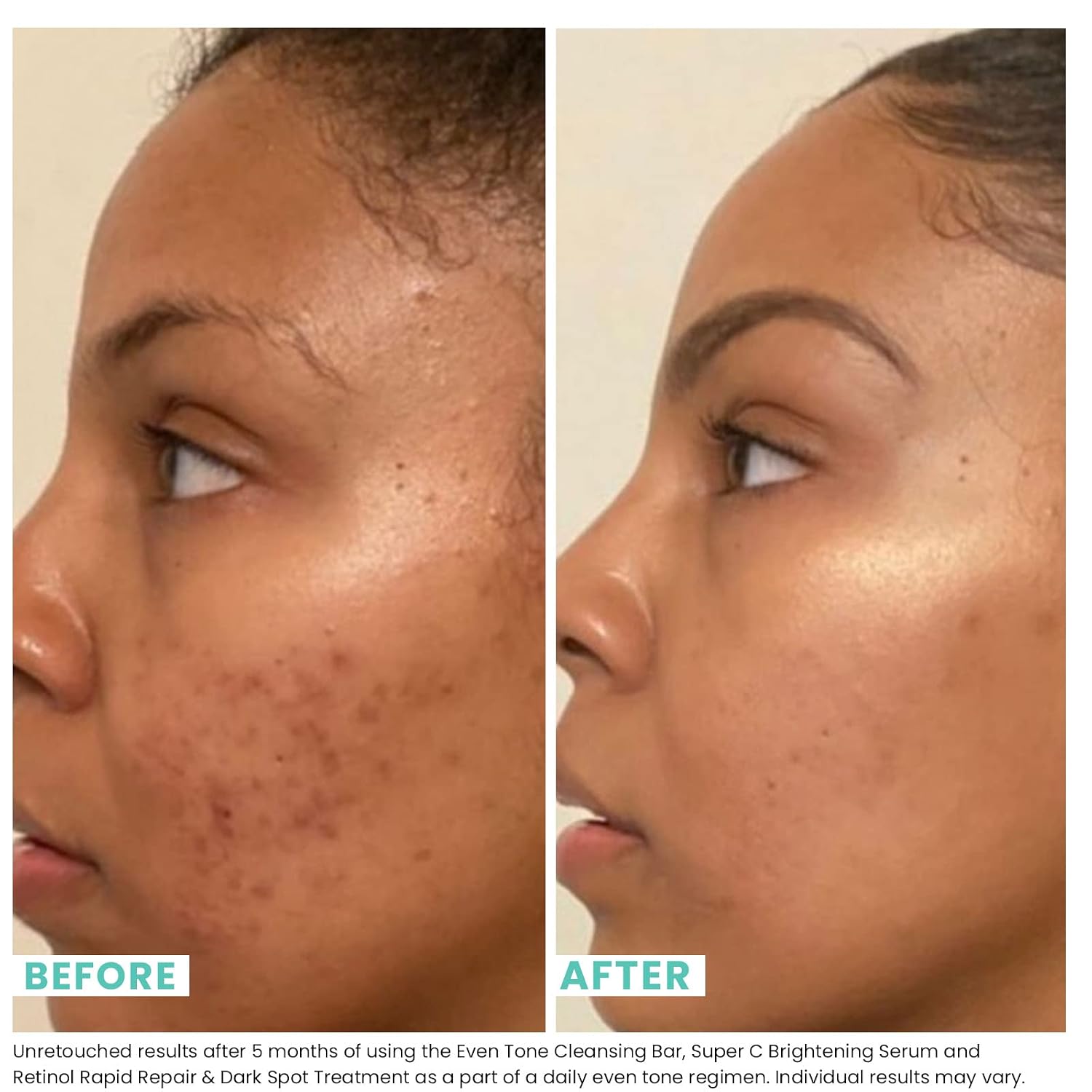 Urban Skin Rx Even Tone Cleansing Bar | 3-in-1 Multitasking Treatment Daily Cleanser, Exfoliator