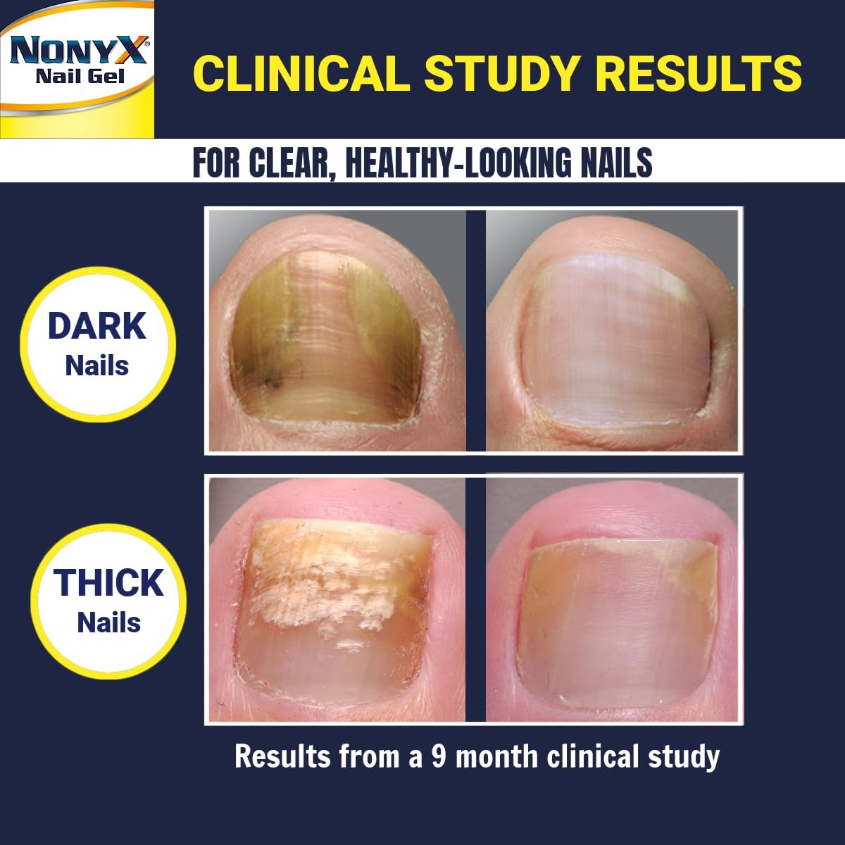 NONYX Fungal Nail Clarifying Gel | Clinically Proven for Discolored, Thick, Brittle, Yellow, Lifted