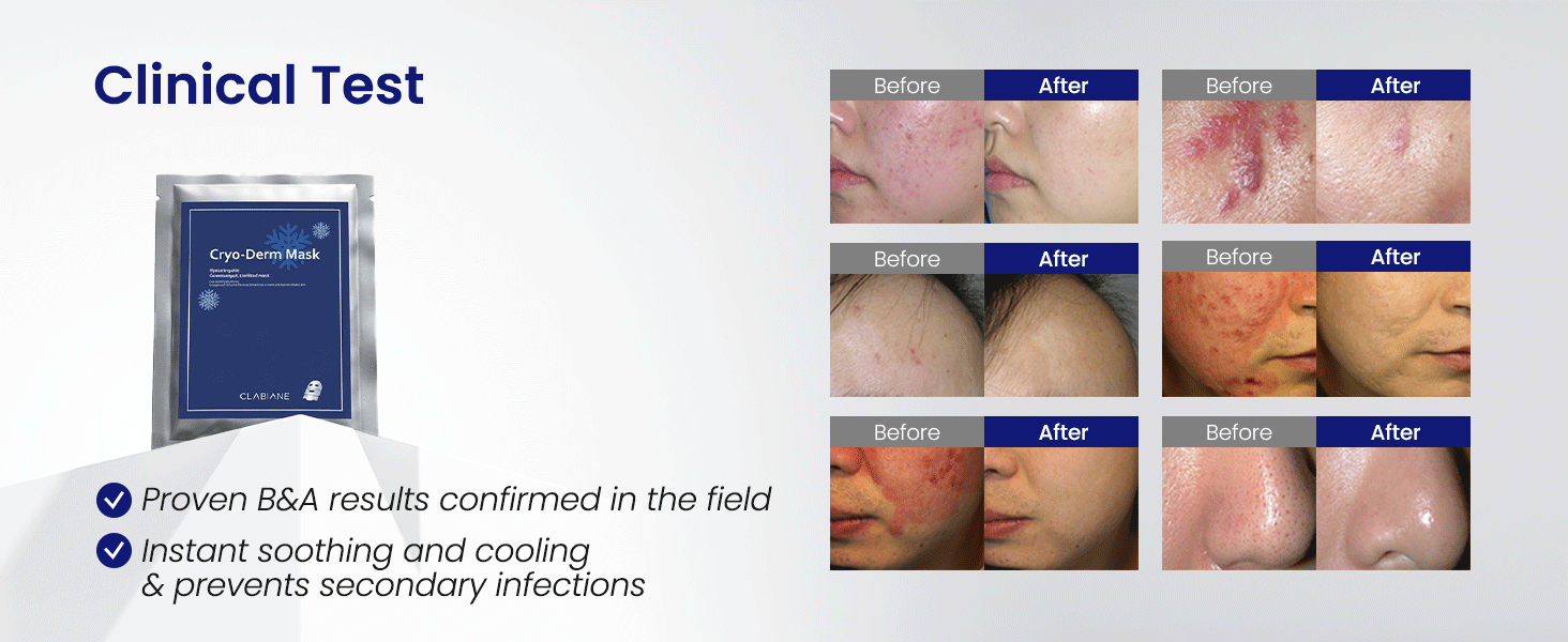 Cryo-Derm Mask
