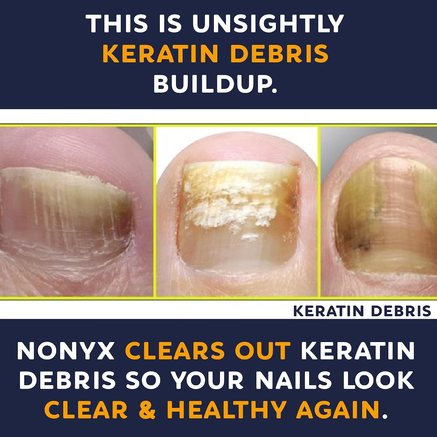 NONYX Fungal Nail Clarifying Gel | Clinically Proven for Discolored, Thick, Brittle, Yellow, Lifted