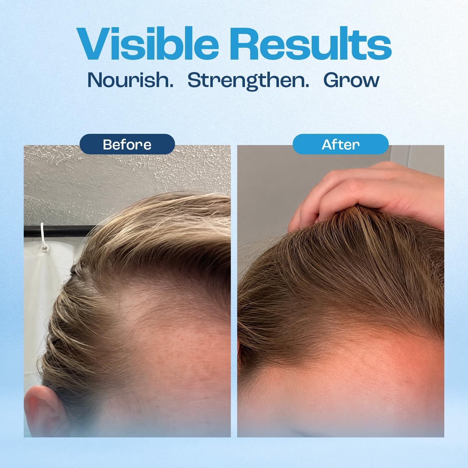 Baby Blues Postpartum Hair Loss Vitamins & Gummies for Women, Biotin & Collagen for Hair Growth Support, Thinning Hair Support