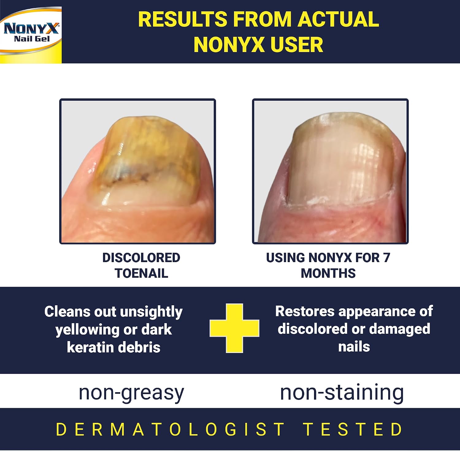 NONYX Fungal Nail Clarifying Gel | Clinically Proven for Discolored, Thick, Brittle, Yellow, Lifted