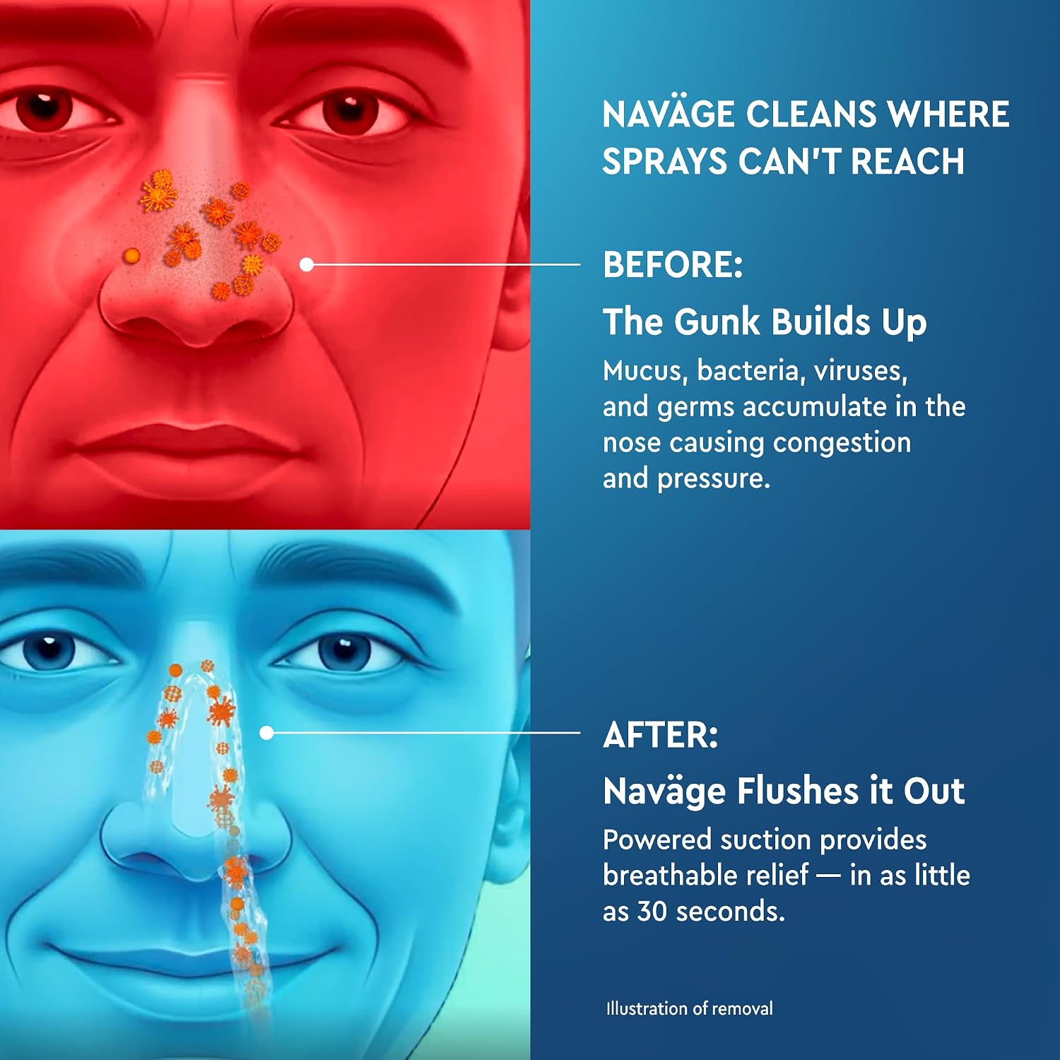 NAVAGE® Deluxe Bundle: Nose Cleaner, 30 SaltPods, Caddy, Black Bag | Deluxe Set: Powered Nose Sinus Cleaner, Storage Caddy, Batteries & Matching Black Travel Bag for Congestion & Sinus Relief