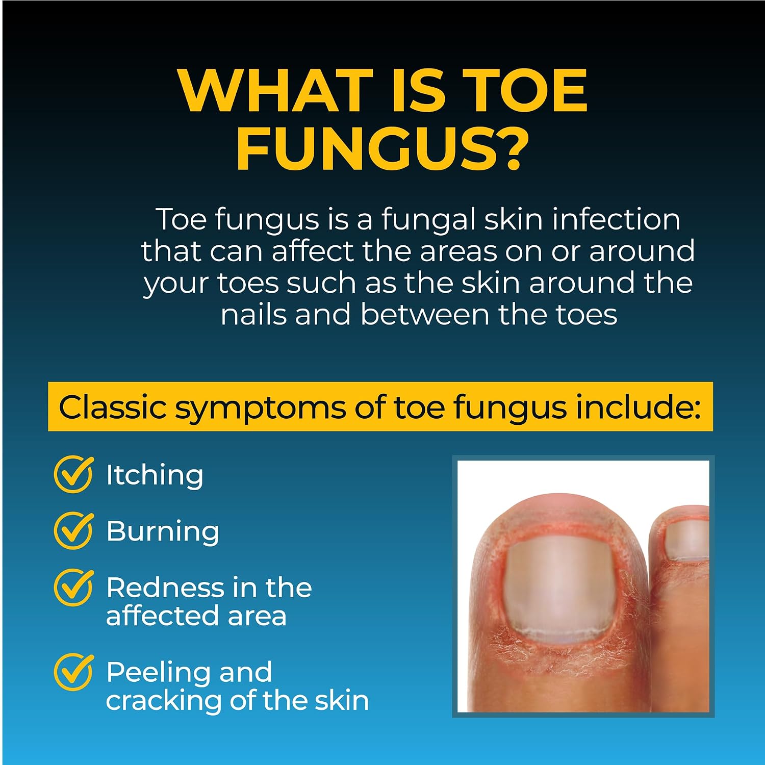 Fungi-Nail Pen Apllicator Anti-Fungal Solution 0.101 Fl Oz