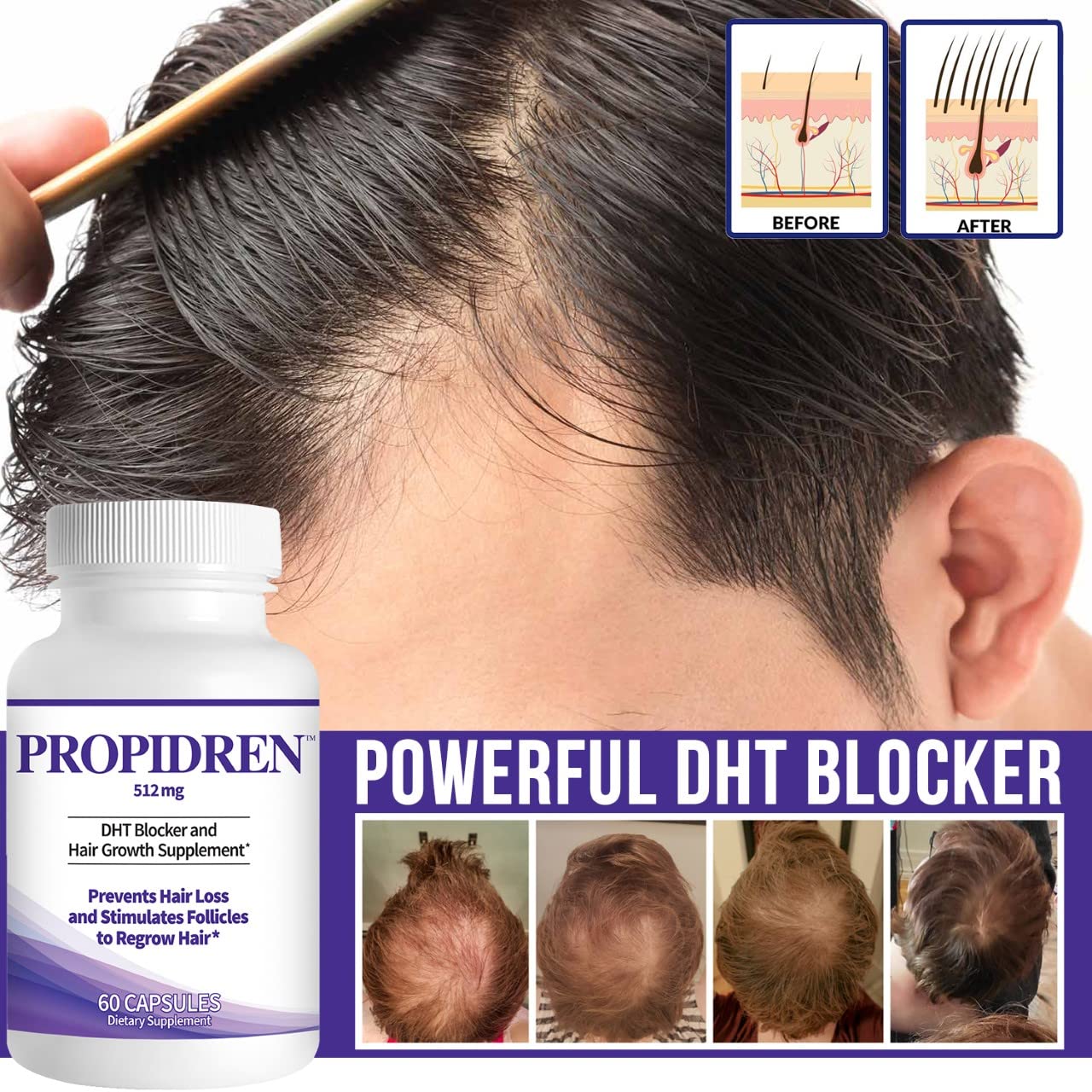 Propidren DHT Blocker & Hair Growth Pills To Stop Hair Loss and Regrow Hair | Hair Vitamins for Men & Women, Regrowth, DHT Blocking, Thinning Hair