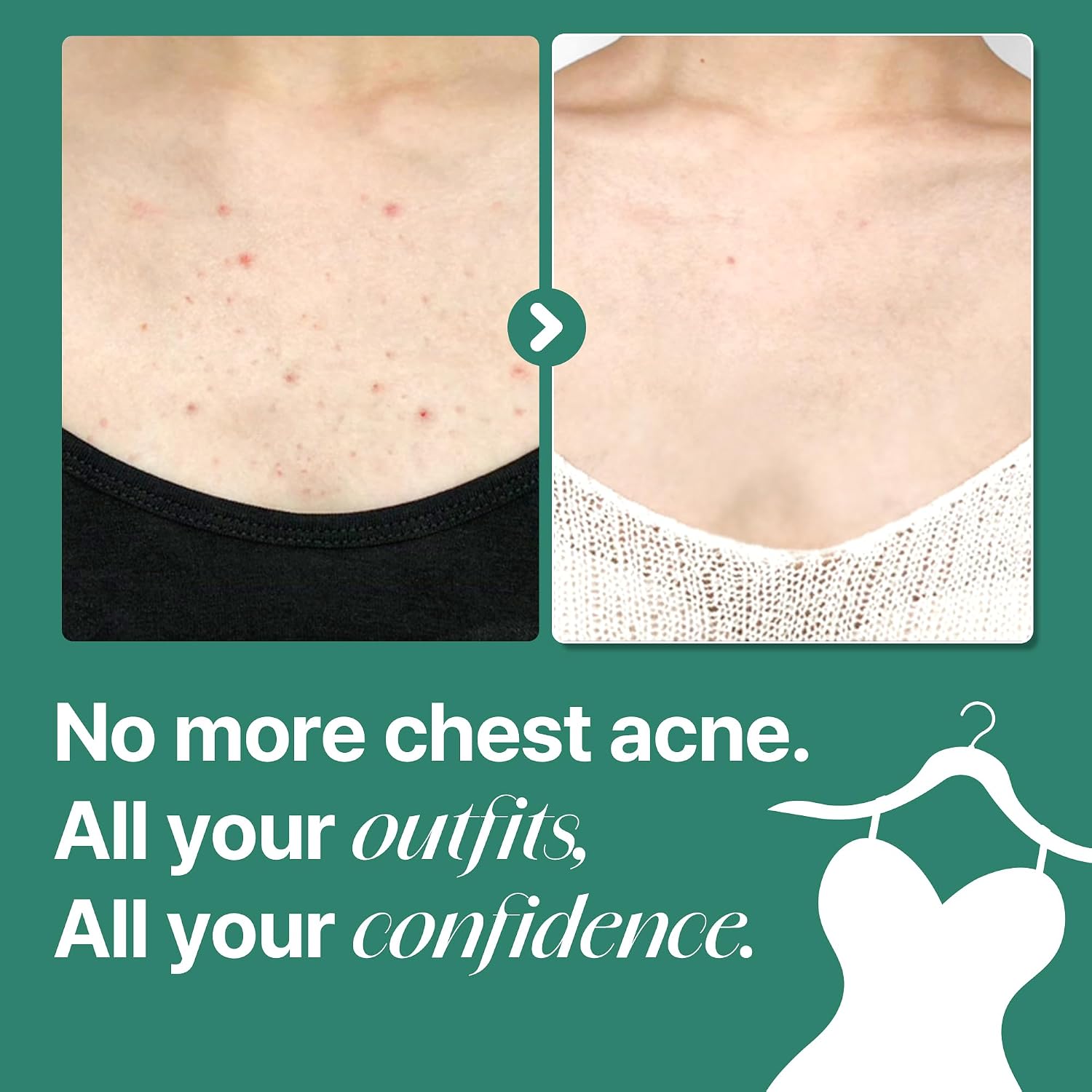SOME BY MI AHA BHA PHA 30 Days Miracle Acne Clear Body Cleanser 13.5oz – Salicylic Acid & Tea Tree Acne Body Wash – Deep Cleansing