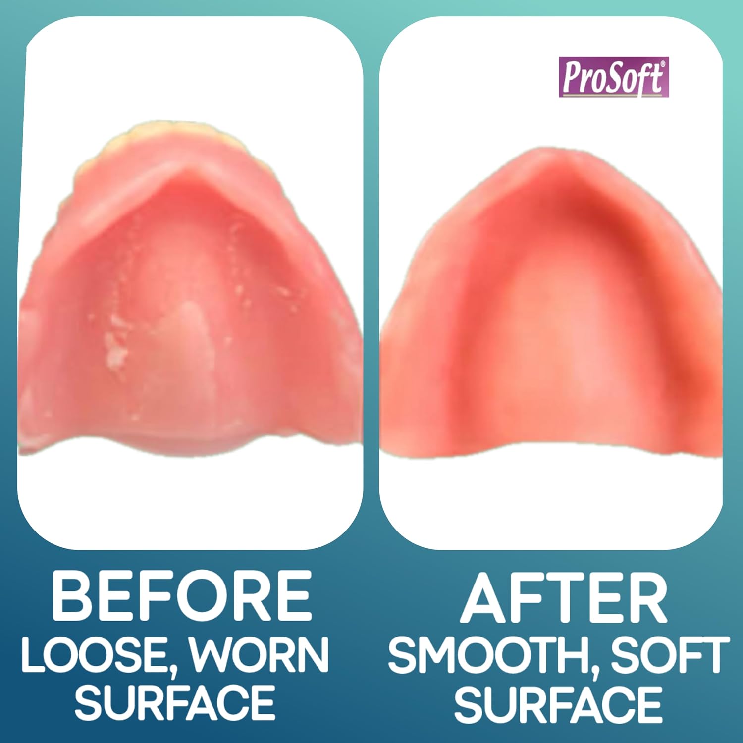 ProSoft Denture Reline Kit (2 Pack)