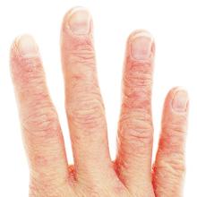 dry cracked chapped skin hands knuckles fingers nourish moisturizer