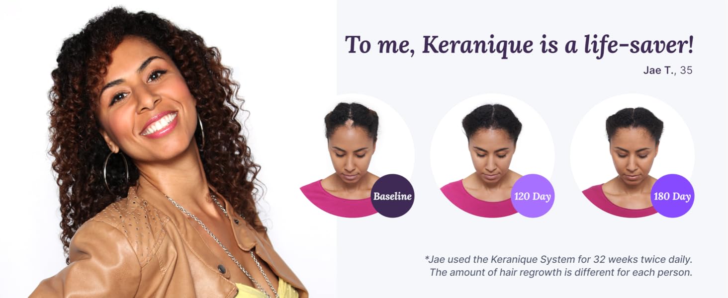 Hair regrowth transformation of woman with 3c hair, who struggled with hair thinning and bald spots