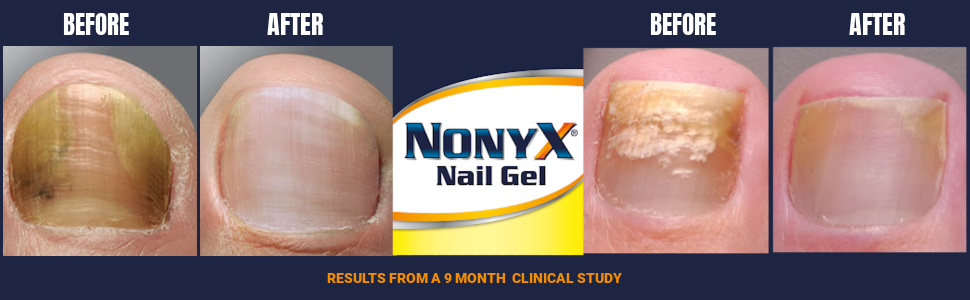From a 9 month clinical study