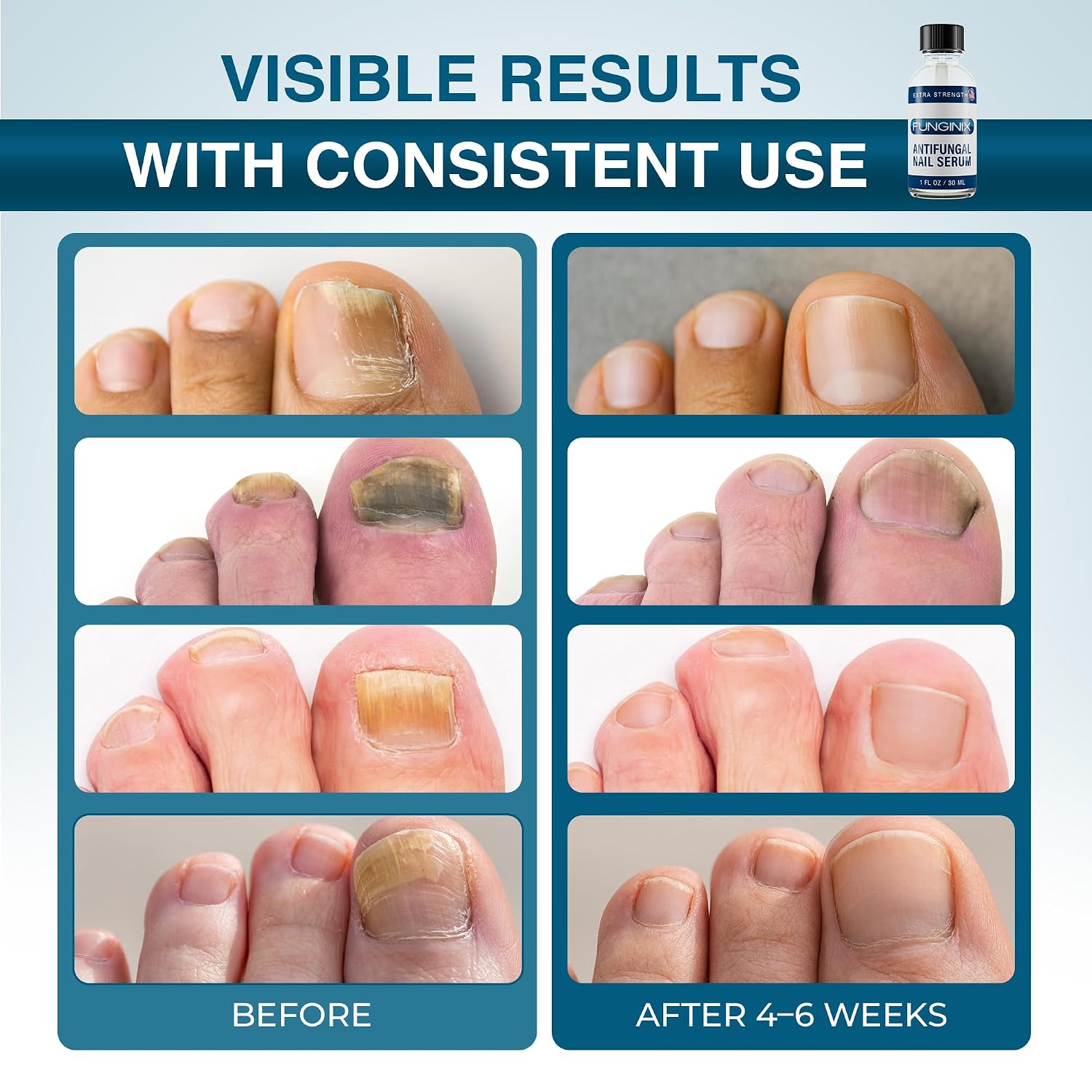 FUNGINIX Toenail Fungus Treatment Extra Strength - Antifungal Nail Treatment With 10% Undecylenic Acid & Tea Tree Oil - Includes Natural Oils & Botanicals - Made in USA (Packaging Does Vary)