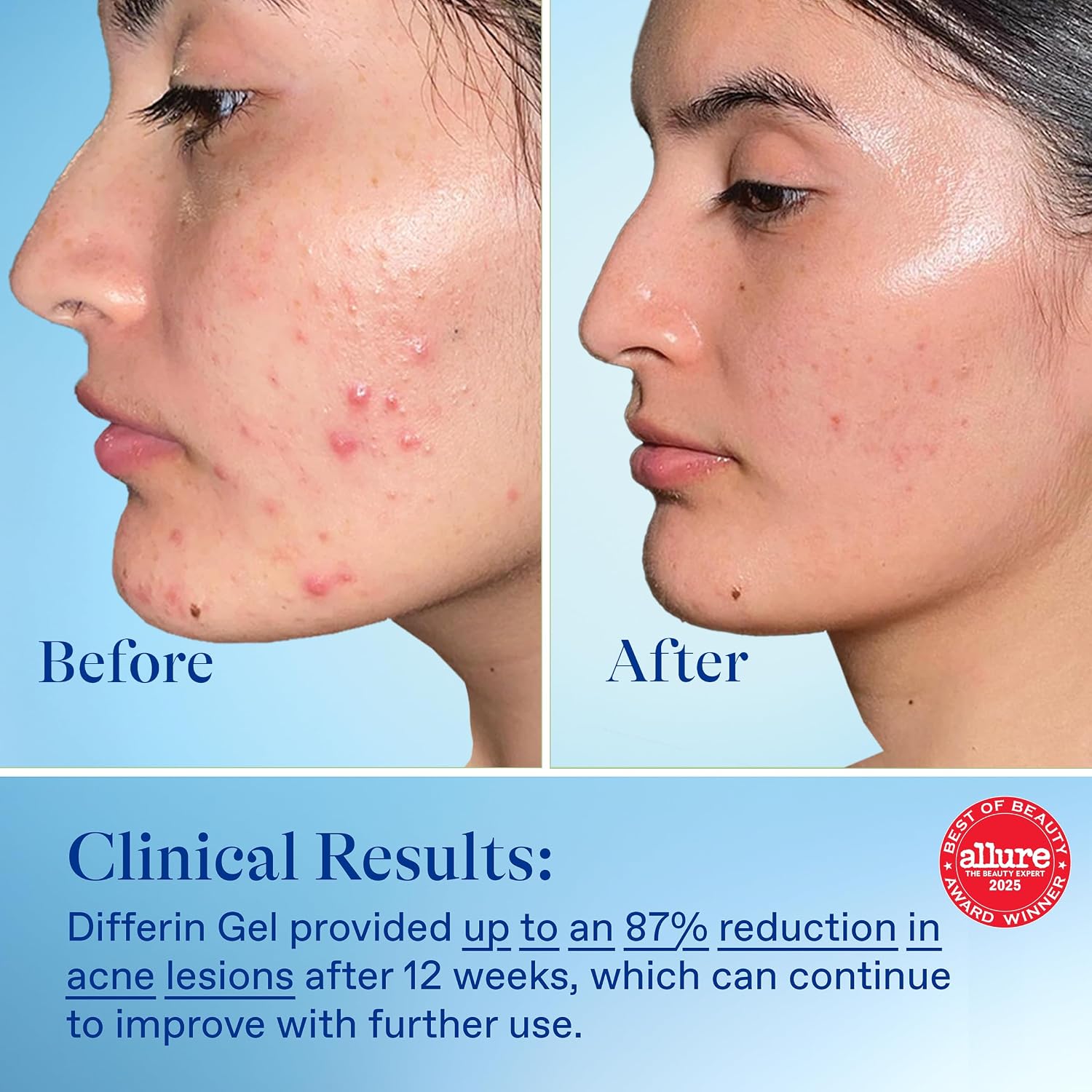 Differin Acne Retinoid Treatment Gel, 0.1% Adapalene, 45g Tube, 2ct