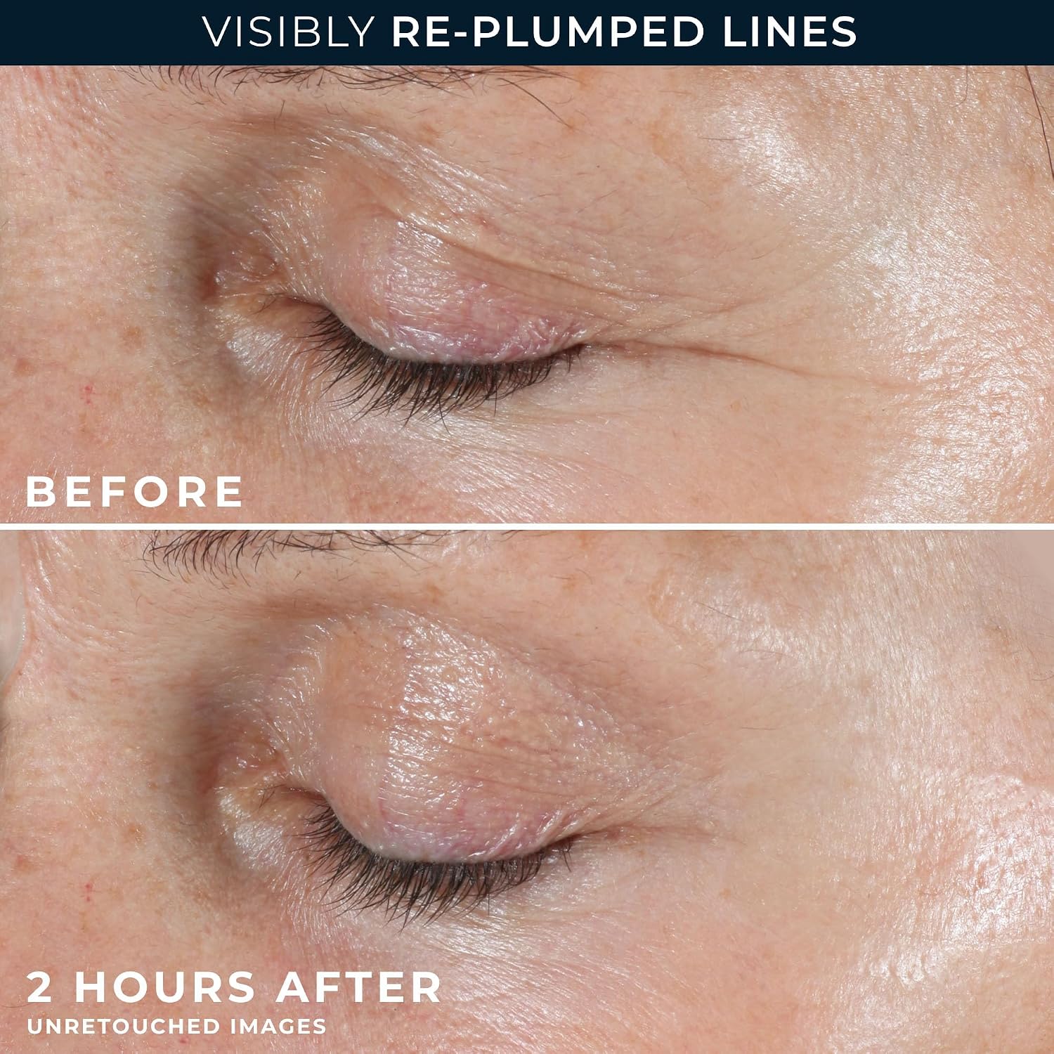 RoC Retinol Correxion Wrinkle Filler for Deep Wrinkles with Hyaluronic Acid | 1oz retinol serum for face, skin care for women and men, visibly reduce fine lines, clinically proven, packaging may vary