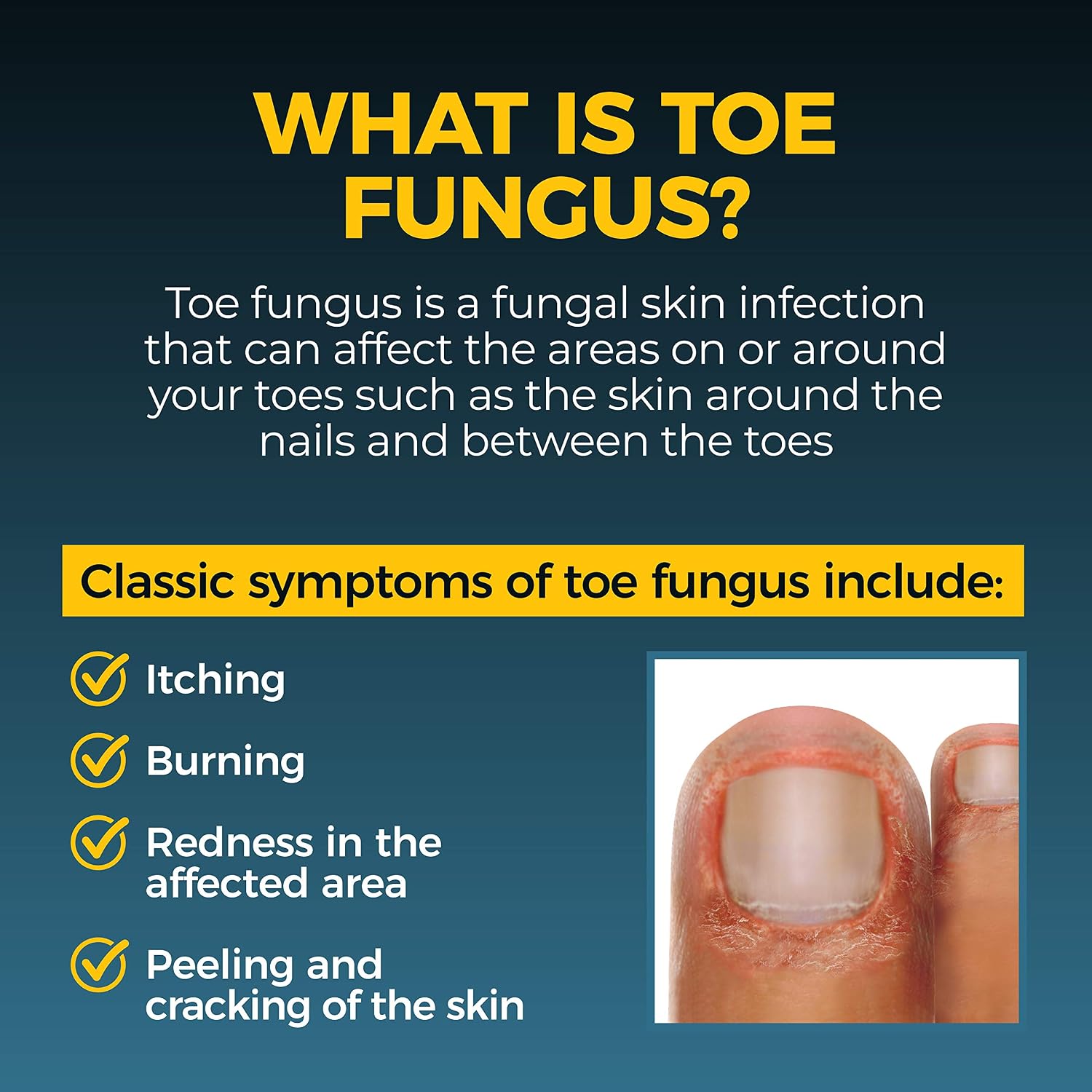 Fungi-Nail Pen Apllicator Anti-Fungal Solution 0.101 Fl Oz