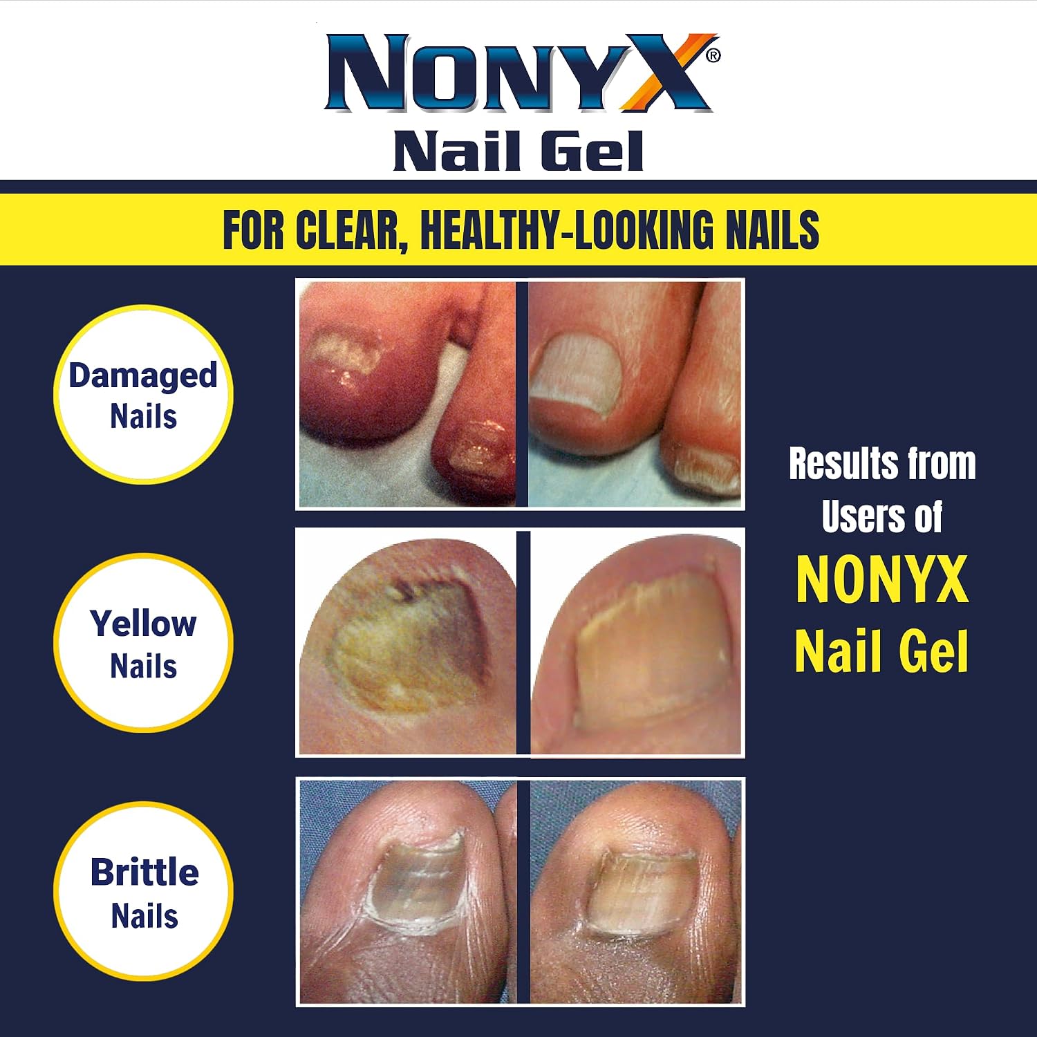 NONYX Fungal Nail Clarifying Gel | Clinically Proven for Discolored, Thick, Brittle, Yellow, Lifted
