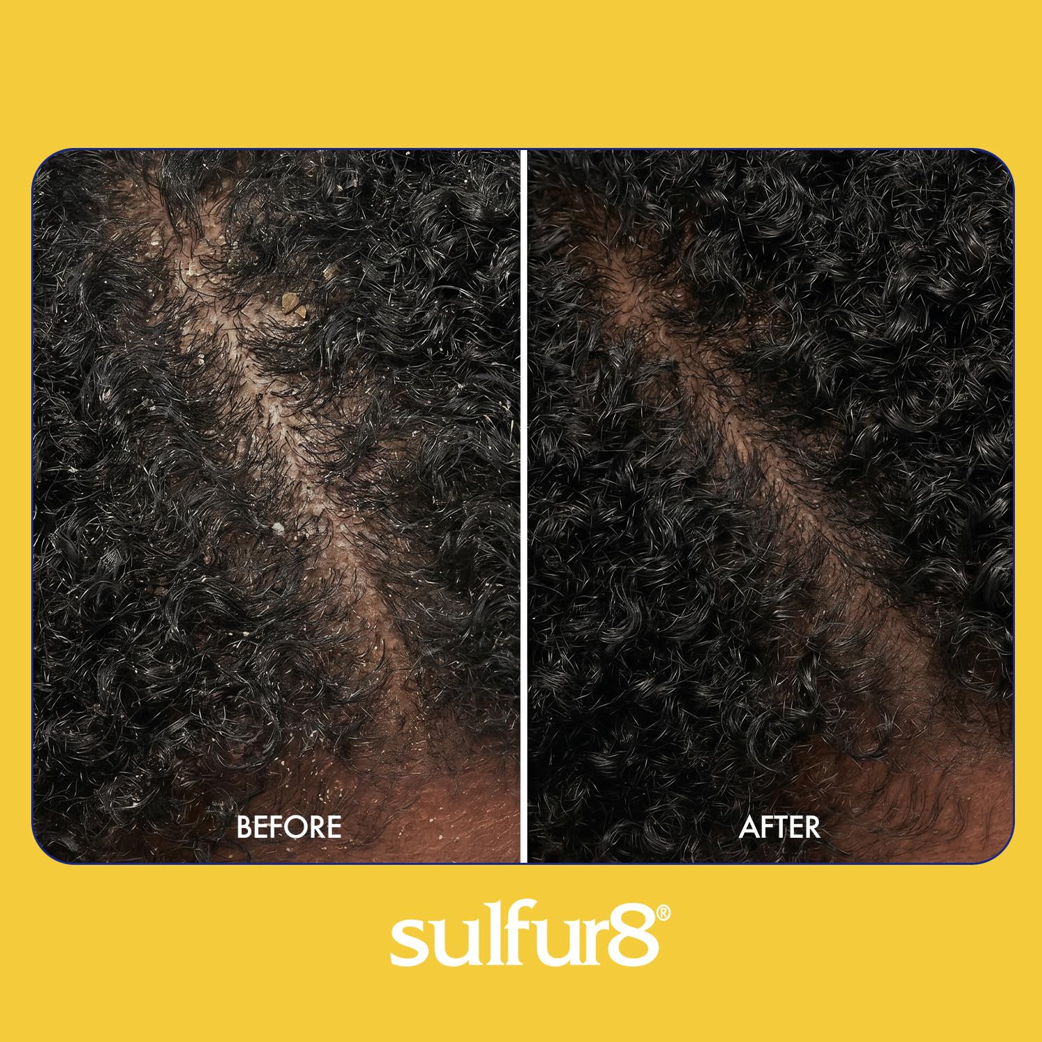 SULFUR8 Anti-Dandruff Shampoo for Kids 7.5 oz – Gentle Medicated Dandruff Control for Itchy Scalp, Mild Cleanse with Kid-Friendly Fresh Fragrance for Children & Sensitive Scalps
