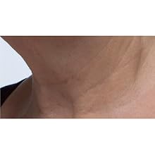 Peter Thomas Roth, Potent-C Power Serum, neck, after