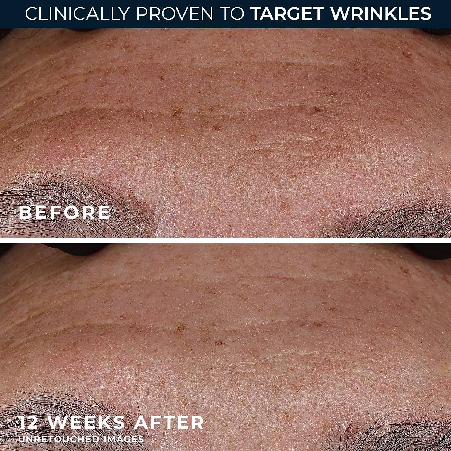 RoC Retinol Correxion Wrinkle Filler for Deep Wrinkles with Hyaluronic Acid | 1oz retinol serum for face, skin care for women and men, visibly reduce fine lines, clinically proven, packaging may vary