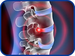 advanced slipped cinturon xs portable pregnancy squats 4x abdominal advance firs chiropractic