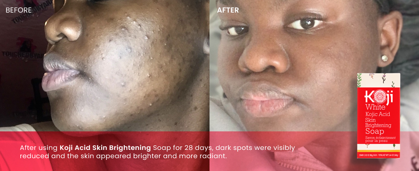 Kojic Acid Skin Brightening Soap