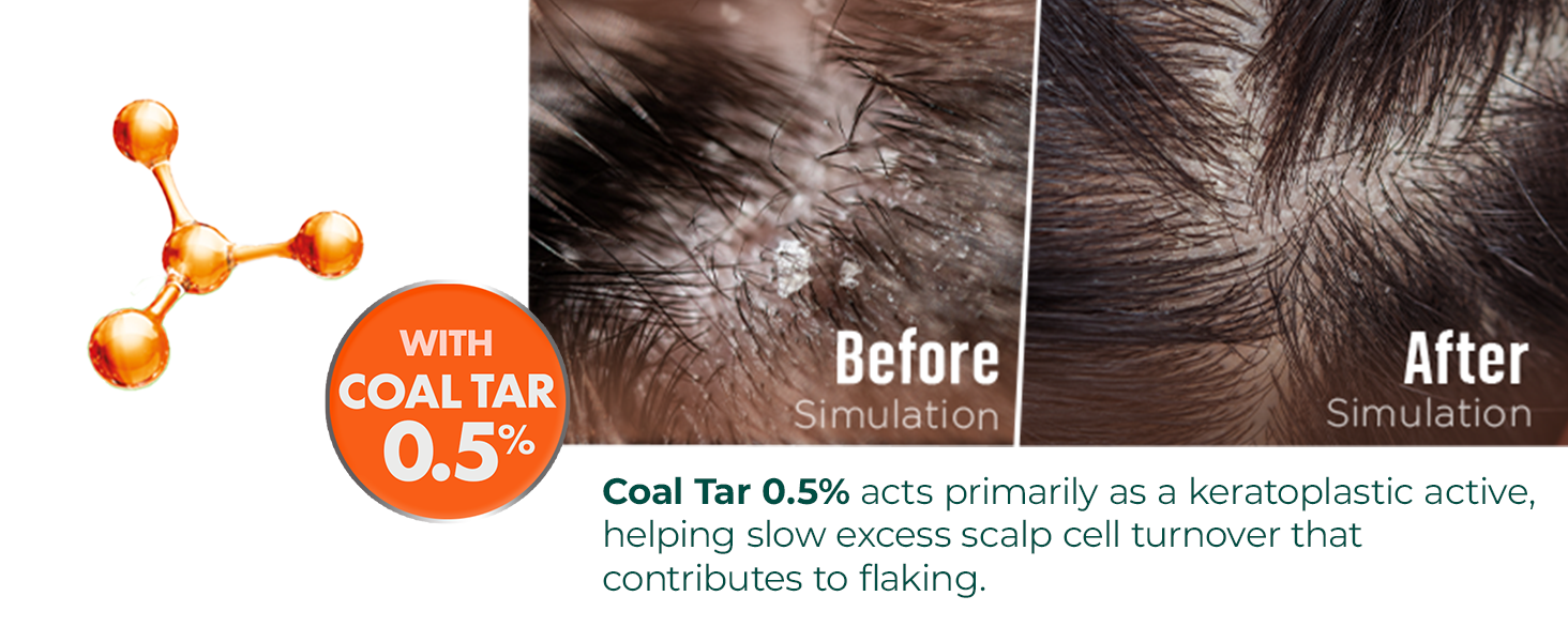 Coal tar 0.5% slows excess scalp cell turnover, before and after simulation of dandruff relief