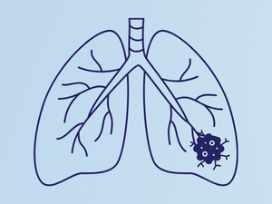 radon causes lung cancer