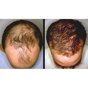Hair loss growth regrowth dht blocker block thin thinning stimulate