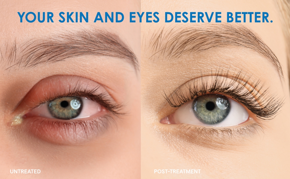 Eye comparison, left eye is irretated, puffy, has a blocked gland. Right eyelid is healthy.