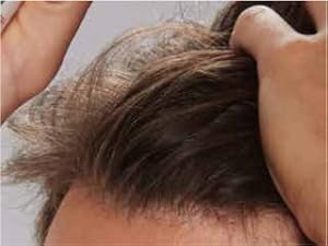 hair growth loss caida pelo crecepelo crecimiento cabello scalp coverage regrowth bald