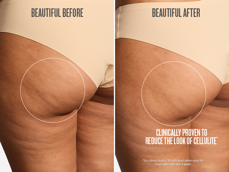 bum bum cream before &amp;amp;amp; after