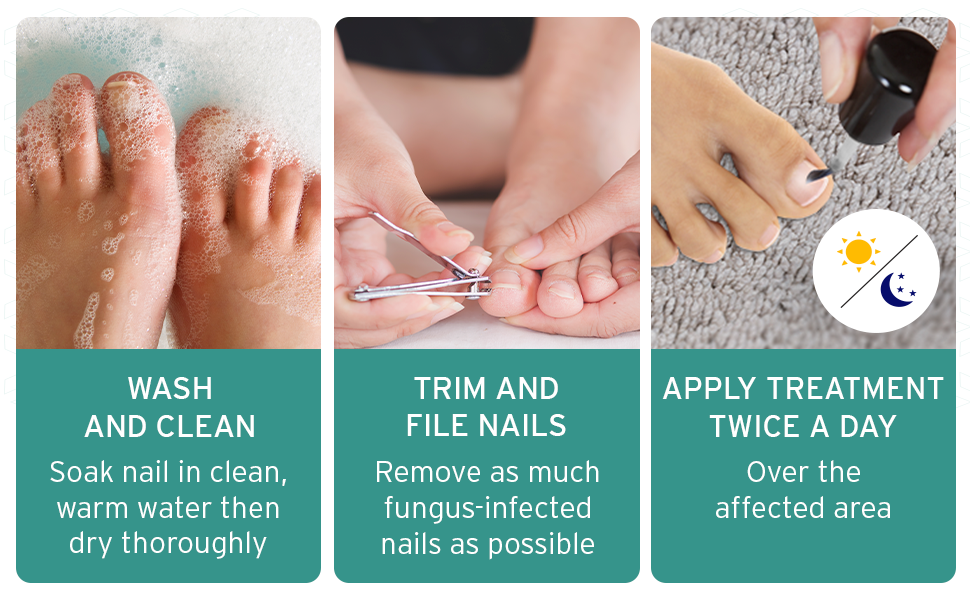 fungus nail treatment