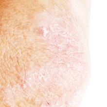 dry cracked chapped skin elbows knees nourish moisturizer