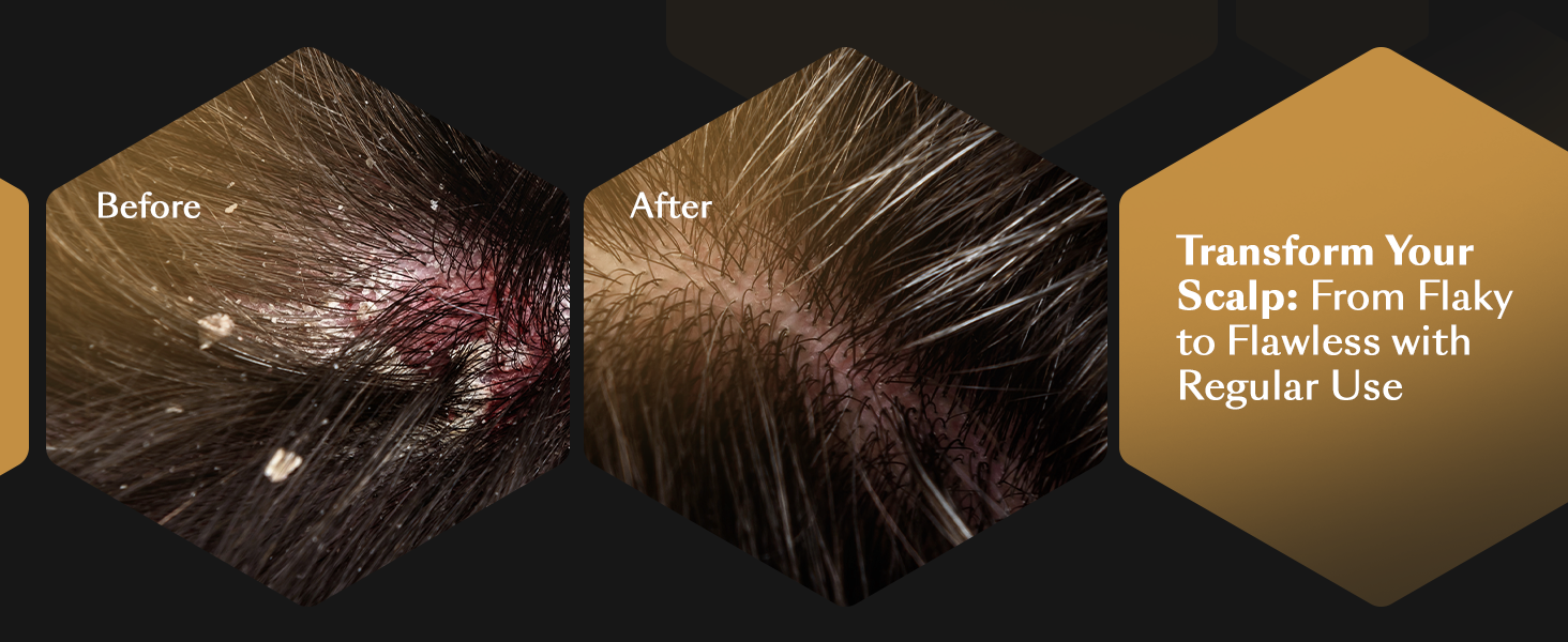 Transform Your Scalp: From Flaky to Flawless with Regular Use.