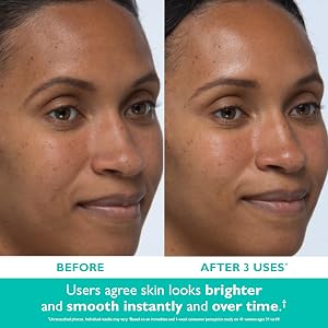 even smoother, instant reveal facial peel, results, before and after, b&amp;a