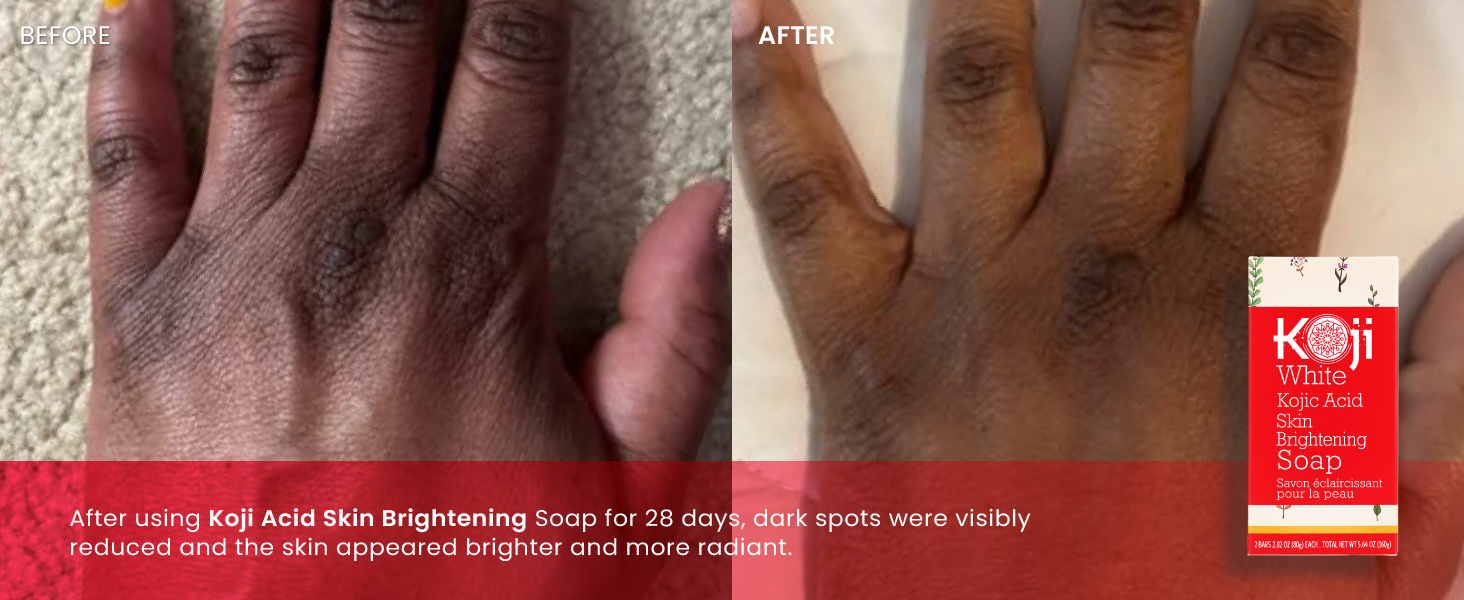 Kojic Acid Skin Brightening Soap