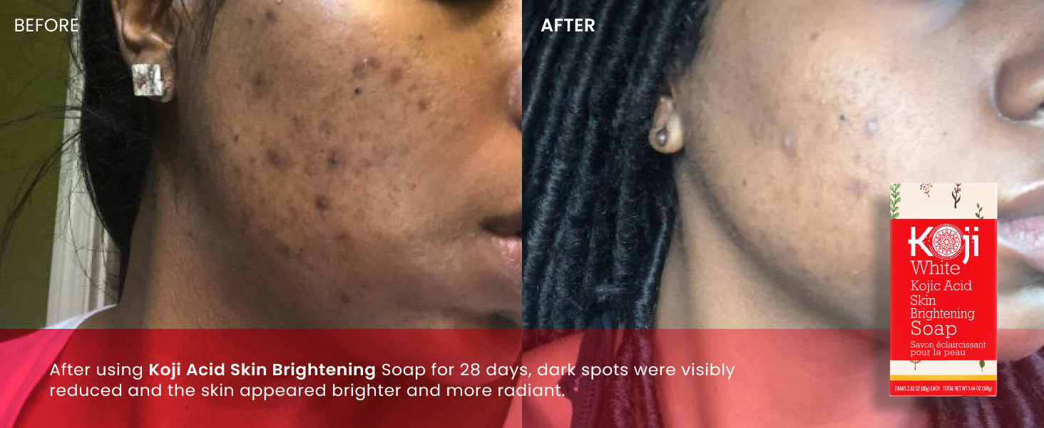 Kojic Acid Skin Brightening Soap