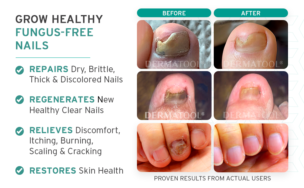 toe nail fungus treatment extra strength