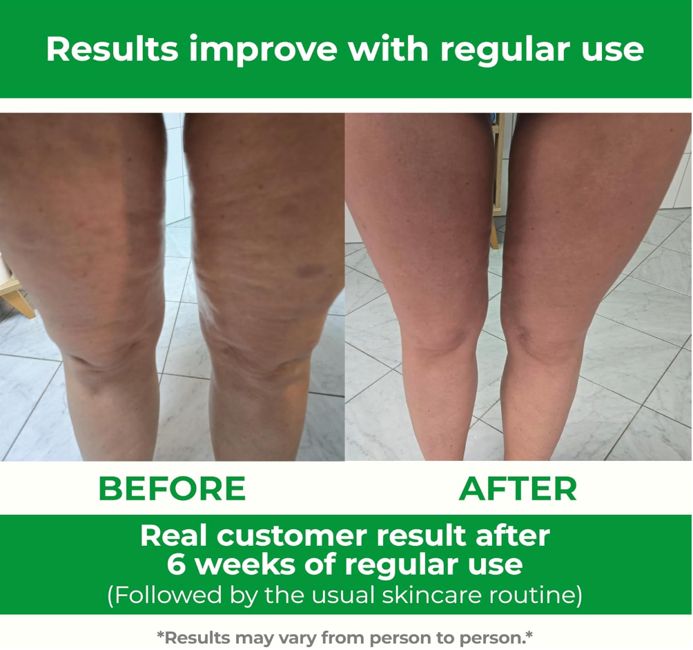 Cellulite Manual Massager Roller for Thighs and Buttocks Made in Italy and patented, with converging and diverging roller technology for targeted anti-cellulite massage.