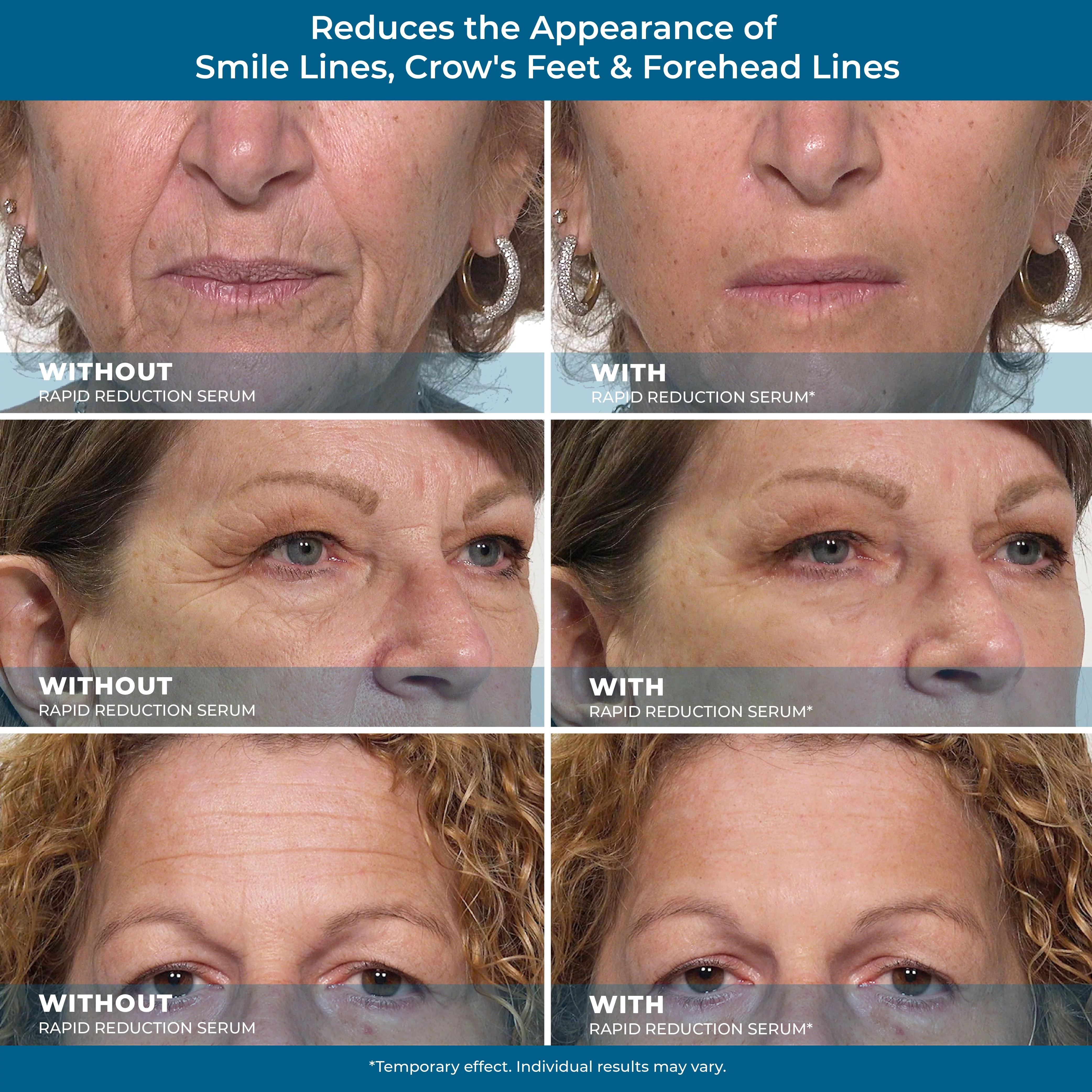 Plexaderm Rapid Reduction Eye Serum - Advanced Formula Anti Aging Visibly Reduces Under-Eye Bags, Wrinkles, Dark Circles, Fine Lines & Crow'