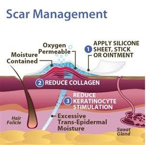 Pro-Sil Patented Silicone Scar Treatment Stick - Clinically