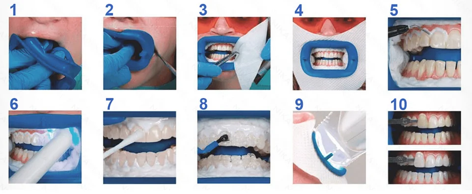 Professional Office Philips Zoom Whitening Kit Chairside Light-Activated, 2 Person Complete Procedures Teeth Whiteninhg Zoom Kit - Radiant Selections