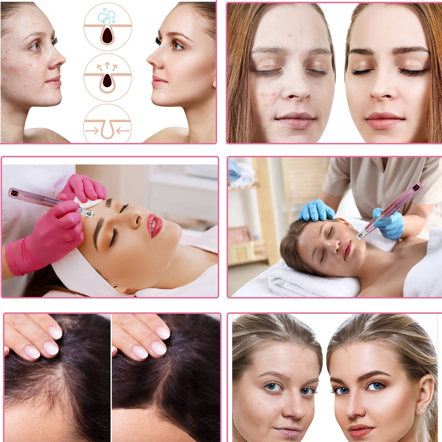 Loutsbe Cordless Electric Microneedling Pen 21000RPM, Professional Dermapen Machine With 30 Pcs Replace Cartridege (12-pins ×10, 36pins×10