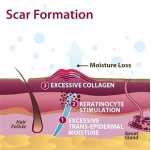 Pro-Sil Patented Silicone Scar Treatment Stick - Clinically