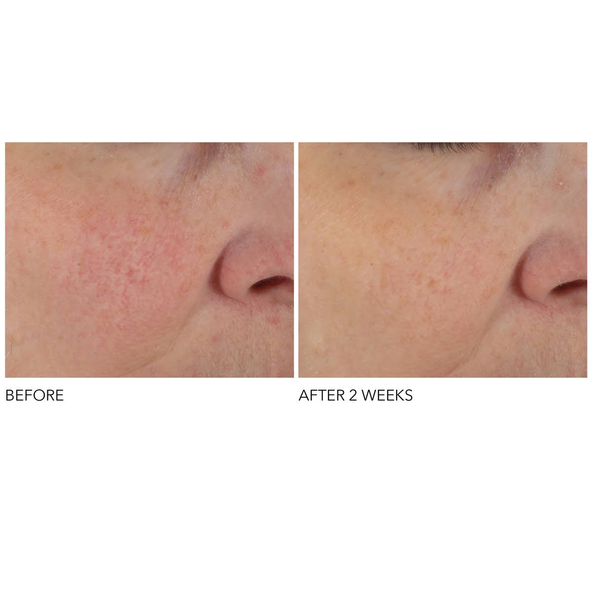 Dr. Dennis Gross Skincare Advanced Retinol + Ferulic Overnight Texture Renewal Peel