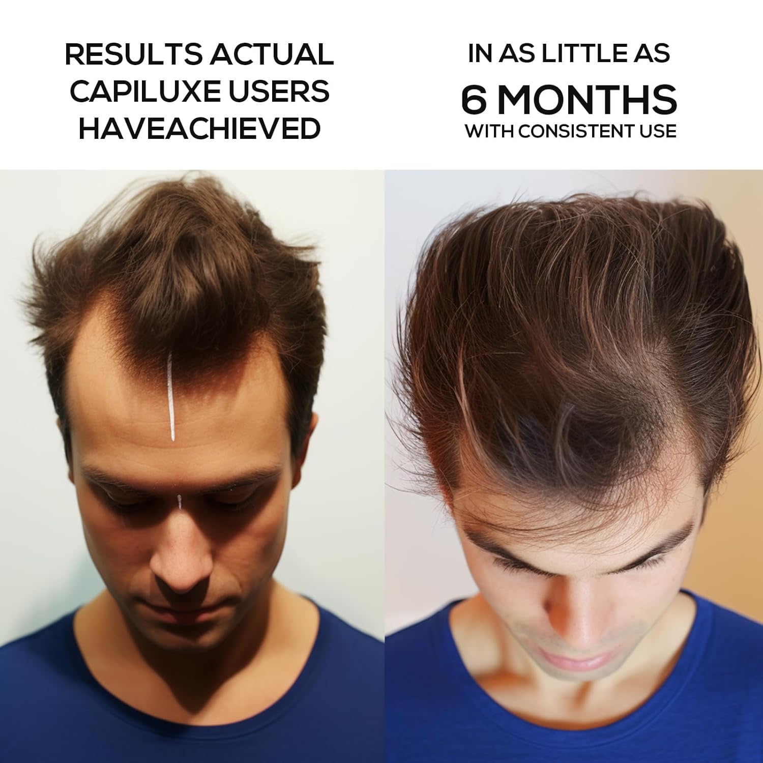 Laser Hair Growth Cap, Laser Therapy Cap for Hair Regrowth, Hair Regrowth Treatments Laser Cap