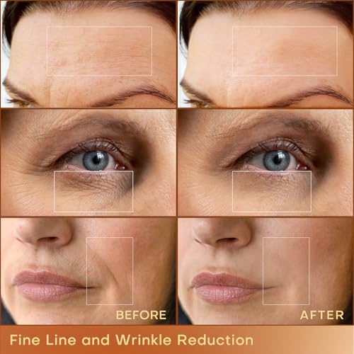 MLAY Professional RF Beauty Machine, Radio Frequency Face Machine with 2 Probes, at Home Radio Frequency Skin Tightening for Lifting
