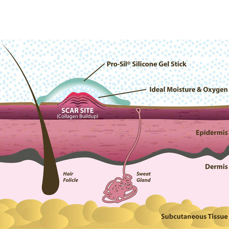 Pro-Sil Patented Silicone Scar Treatment Stick - Clinically
