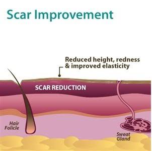 Pro-Sil Patented Silicone Scar Treatment Stick - Clinically