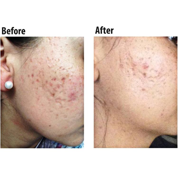 Pro-Sil Patented Silicone Scar Treatment Stick - Clinically