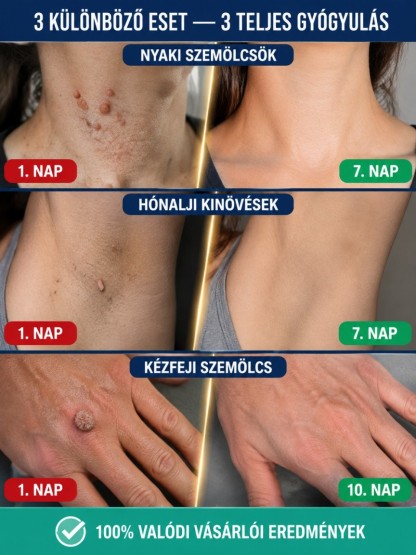 👍Fájdalommentes Bőrhiba Javító Szérum Golyós Adagolóval - Drága Kezelések Helyett- Kockázatmentes Vásárlás
